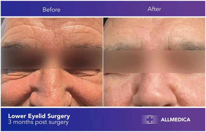 Blepharoplasty Lower Eyelids - before (left) and after (right) result