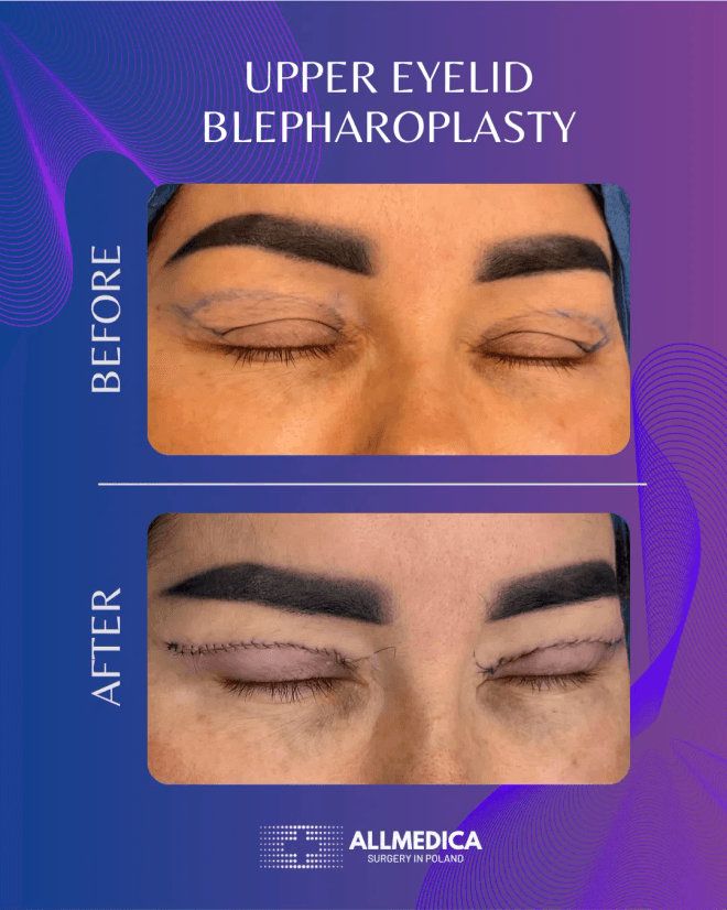Blepharoplasty Upper Eyelids - before (top) and after (bottom) result
