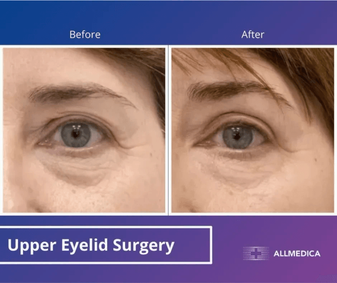 Blepharoplasty Upper Eyelids - before (left) and after (right) result