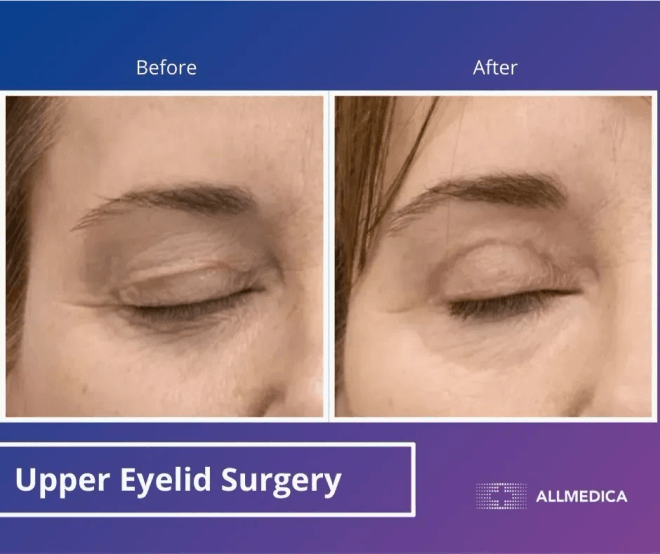 Blepharoplasty Upper Eyelids - before (left) and after (right) result