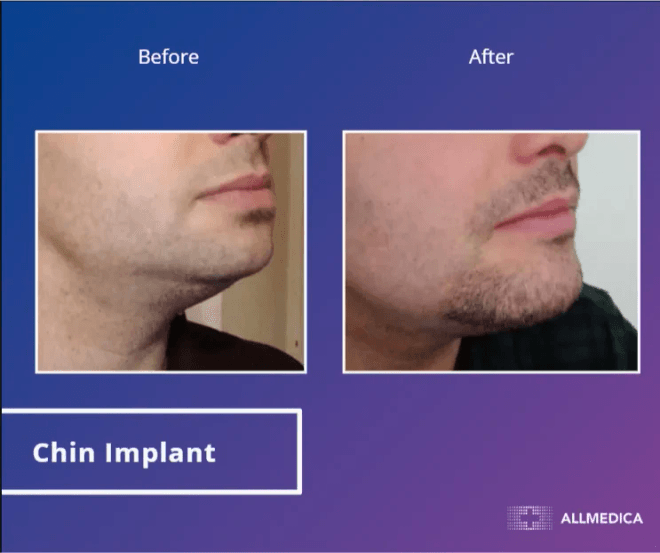 Chin Implant - before (left) and after (right) result