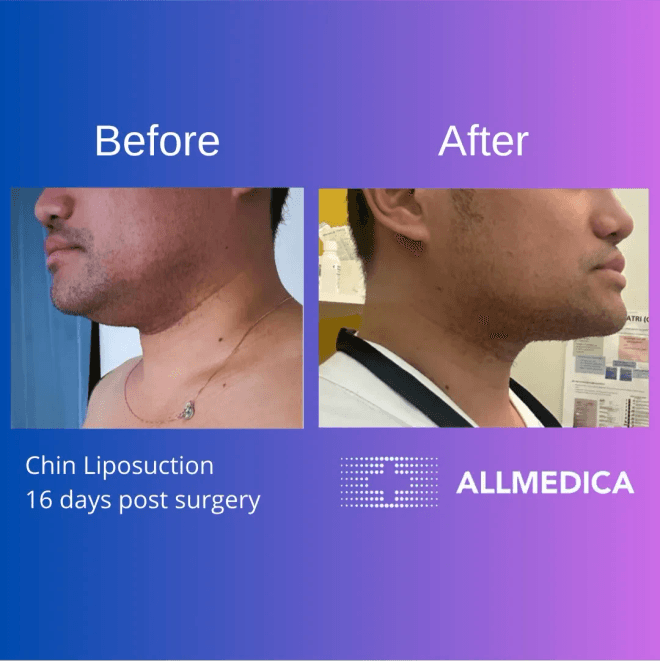 Chin Liposutction - before (left) and after (right) result
