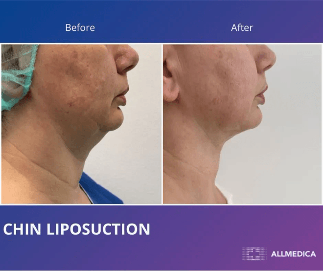 Chin Liposutction - before (left) and after (right) result