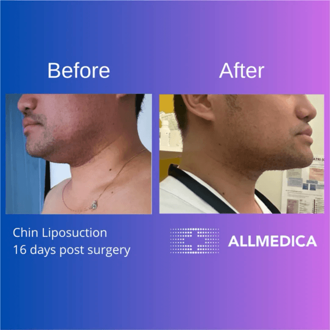 Chin lipo 16 days post surgery