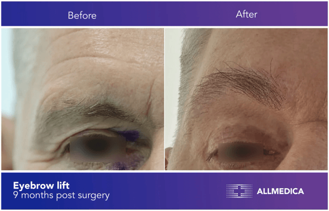 Eyebrow Lift - before (left) and after (right) result