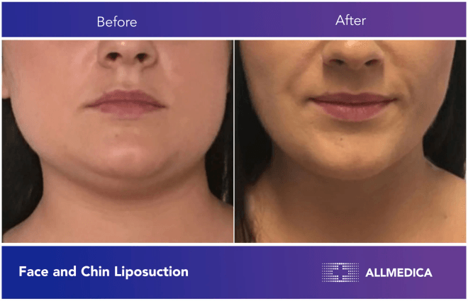 Face And Chin Liposuction - before (left) and after (right) result