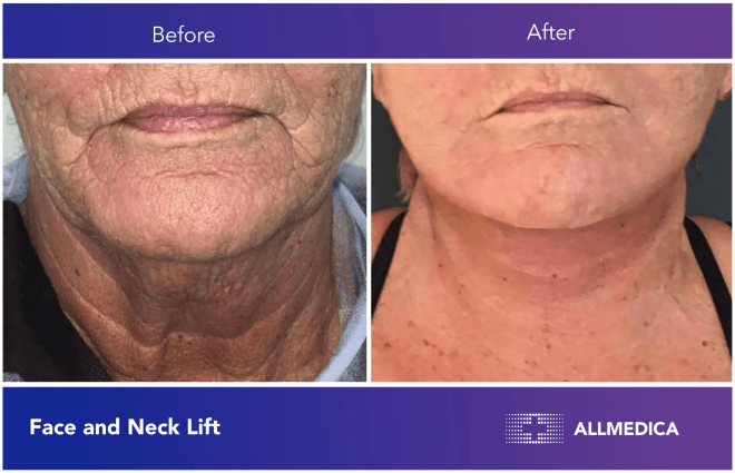 Face And Neck Lift - before (left) and after (right) result