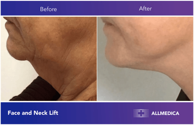 Face And Neck Lift - before (left) and after (right) result