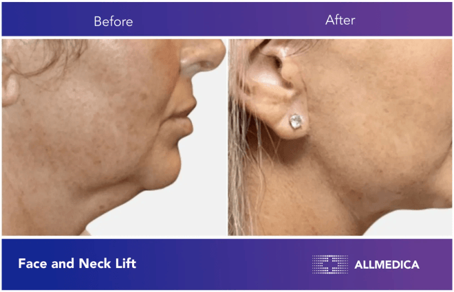 Face And Neck Lift - before (left) and after (right) result