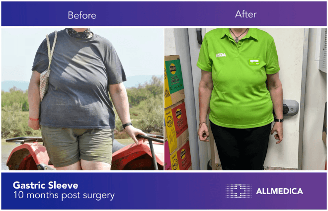 Gastric Sleeve - before (left) and after (right) result