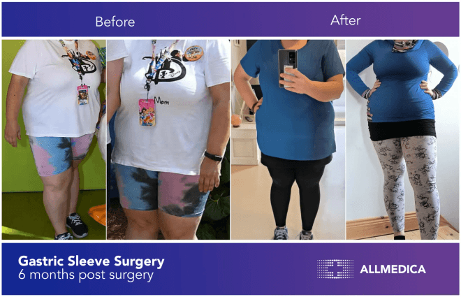 Gastric Sleeve - before (left) and after (right) result