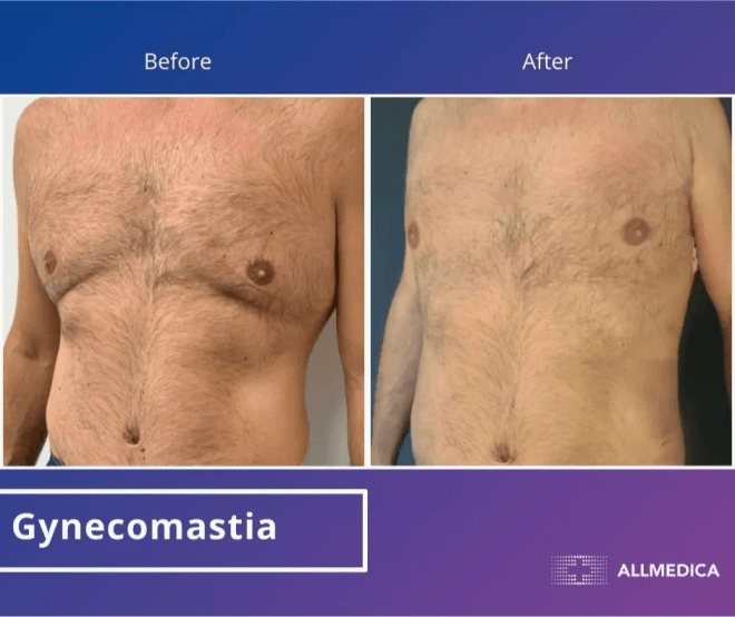 Ginecomasty - before (left) and after (right) result
