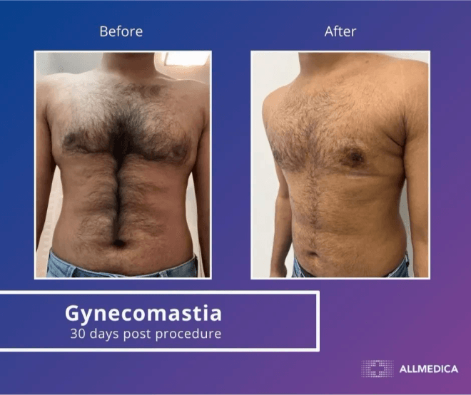 Ginecomasty - before (left) and after (right) result