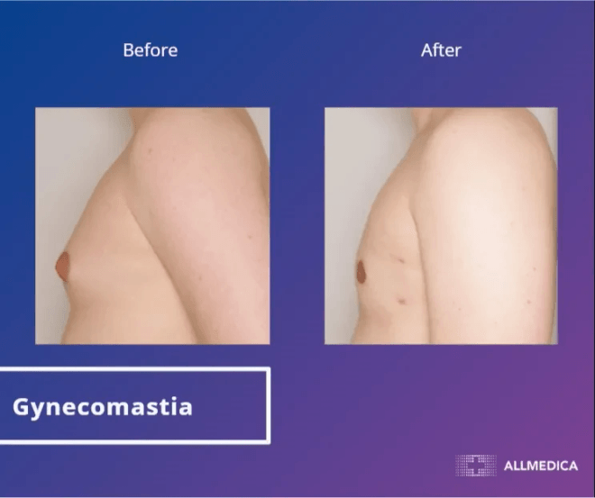 Ginecomasty - before (left) and after (right) result