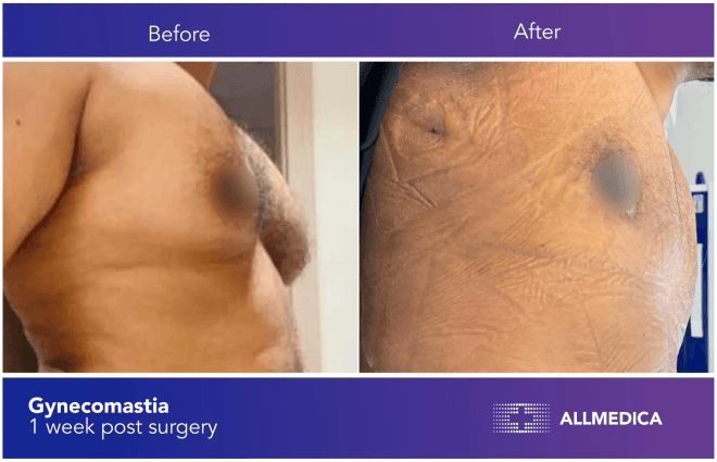 Ginecomasty - before (left) and after (right) result