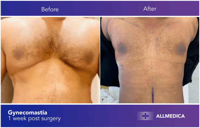 Ginecomasty - before (left) and after (right) result