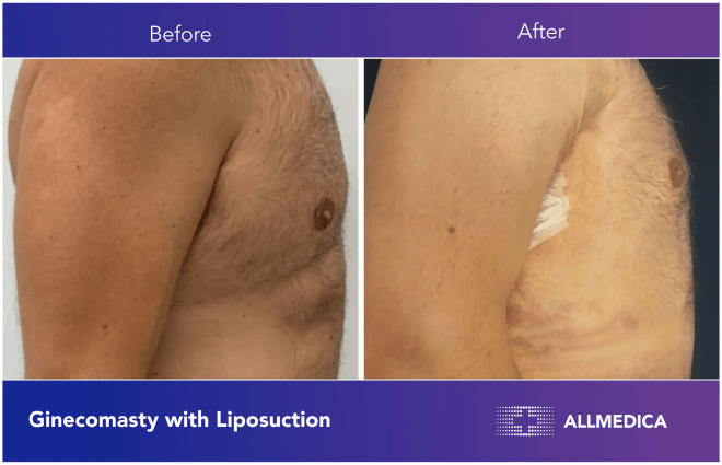 Ginecomasty With Liposuction - before (left) and after (right) result