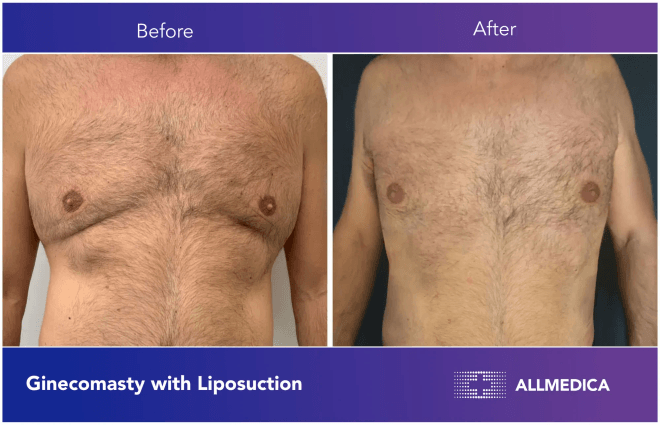 Ginecomasty With Liposuction - before (left) and after (right) result