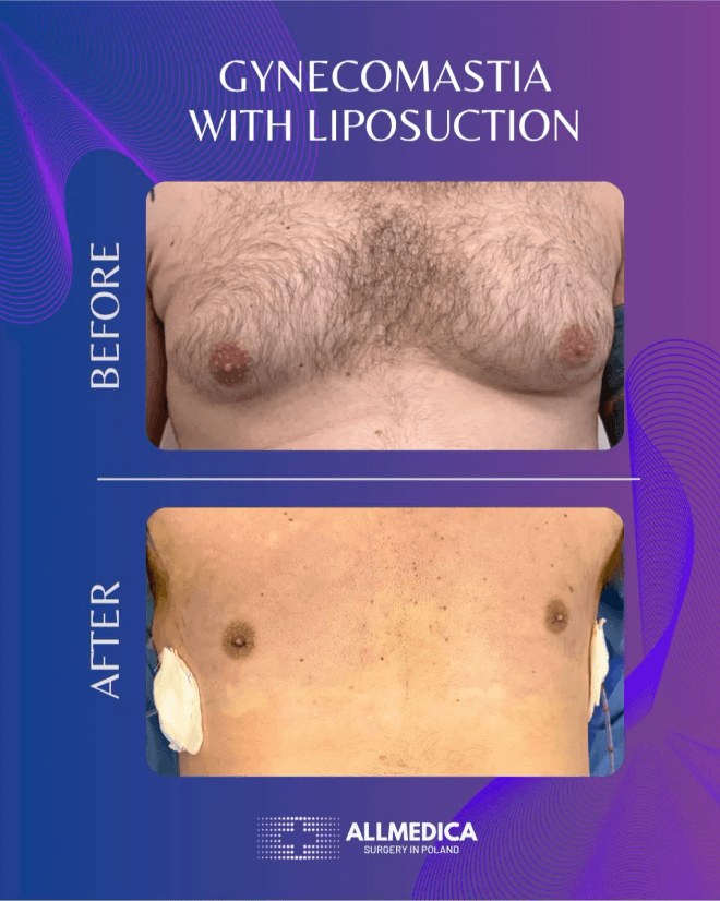 Ginecomasty With Liposuction - before (top) and after (bottom) result
