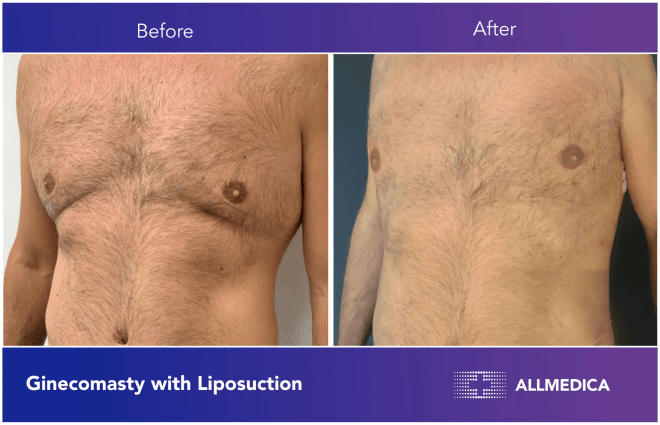 Ginecomasty With Liposuction - before (left) and after (right) result