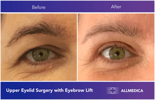 Upper eyelid surgery with eyebrow lift